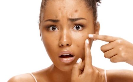 Why Do I Get Acne and How to Get Rid of It?