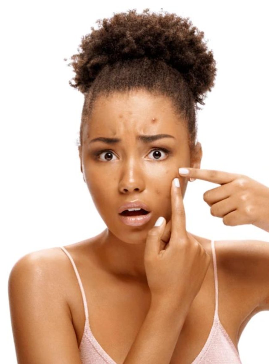 Why Do I Get Acne and How to Get Rid of It?